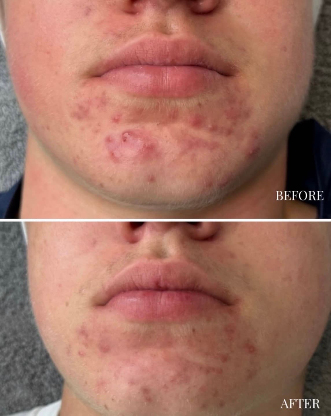 Client photographs before and after a 12-week Dermalux LED and home-care programme