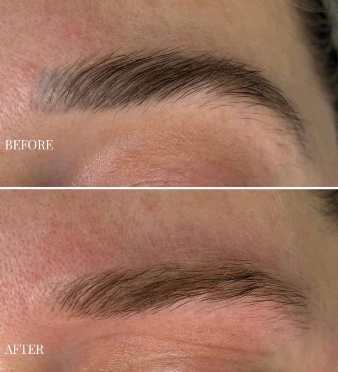 Client photographs before and after laser removal of semi-permanent eyebrow pigment