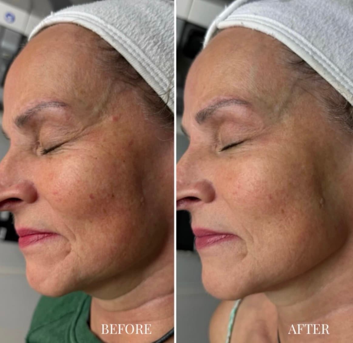 Side-by-side client photographs before and after one IllumiFacial treatment
