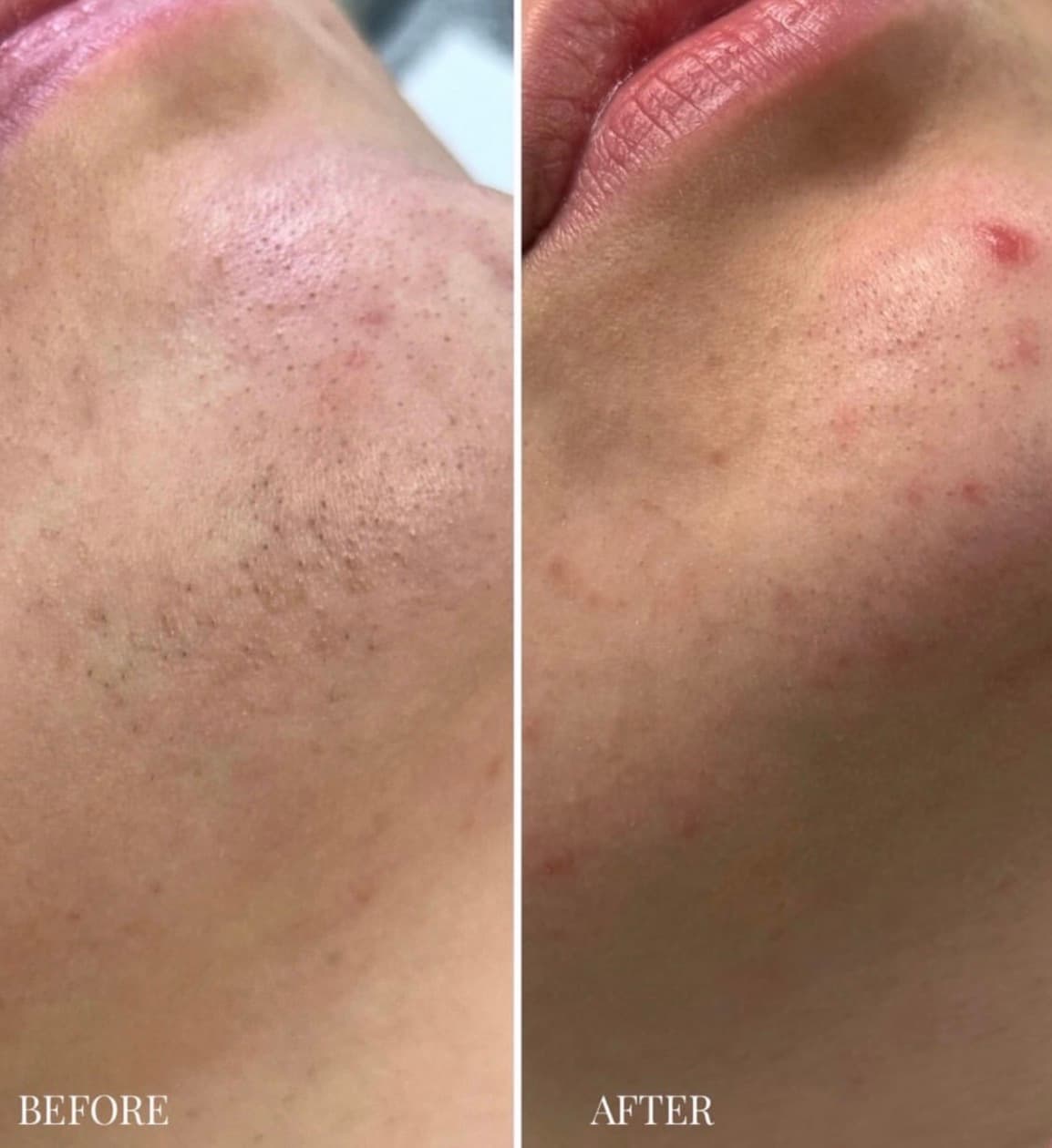 Side-by-side client photographs before and after seven facial laser hair-reduction sessions