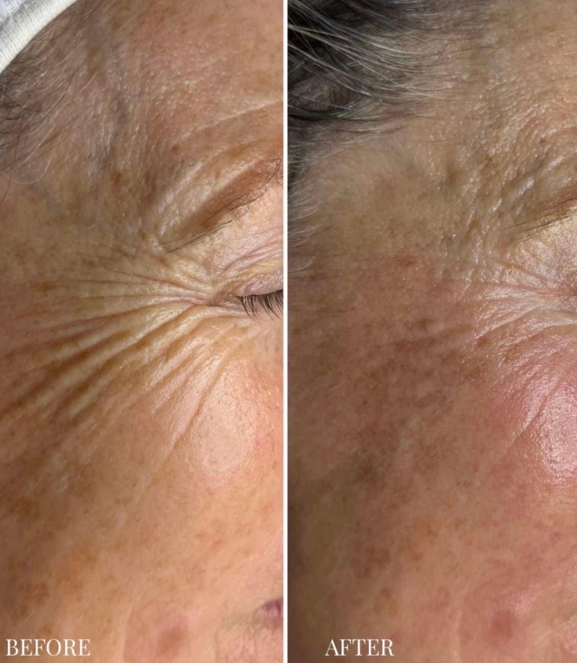 Side-by-side client photographs before and after radiofrequency treatment around the eye area